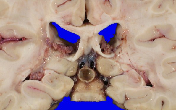 7A2 Pineal cyst (Case 7) 1A