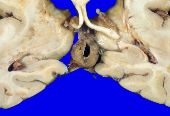 8 Cyst, pineal (Case 8) 2A