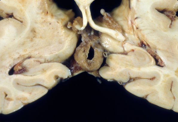 8 Cyst, pineal (Case 8) 2