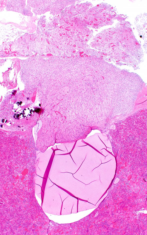 10B2 Rathke's cyst (Case 10) H&E H&E 2X 1