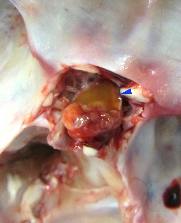 11A Rathke Cleft Cyst, Infarct (Case 11)_2 copy