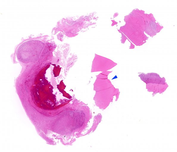 11B1 Rathke Cyst, infarct  (Case 11) copy