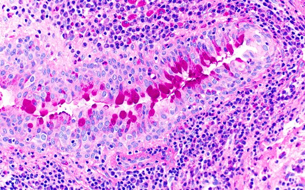 13B6-Cyst-Rathke-s-cleft-Case-13-PAS-40X