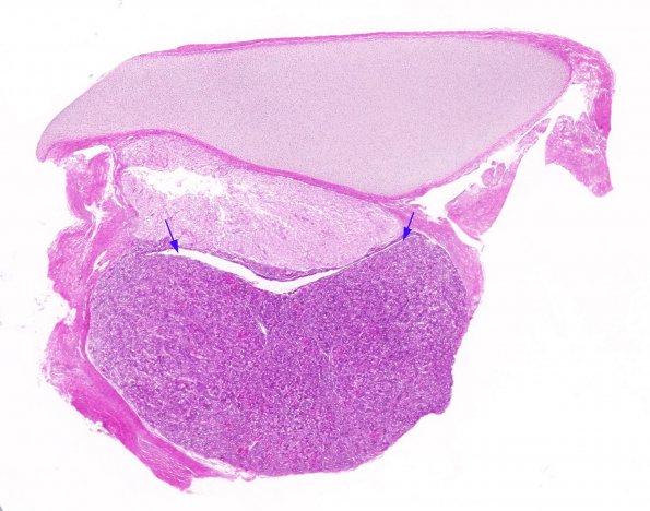 1A1 Rathke's Cleft, (32 wk fetus) (Case 1) H&E