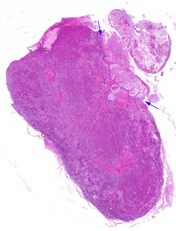 2A1 Cyst, Rathke Cleft (Case 2) H&E