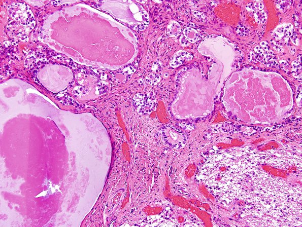 2A2 Cyst, Rathke Cleft (Case 2) H&E 1