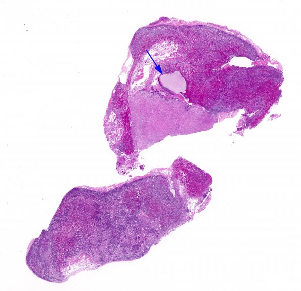 3A1 Cyst, Intermediate Lobe, (Case 3) H&E