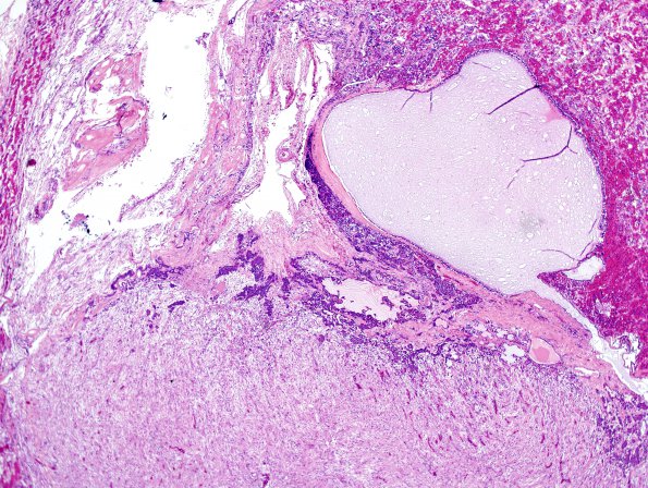 3A2 Cyst, Intermediate Lobe, (Case 3) H&E 2