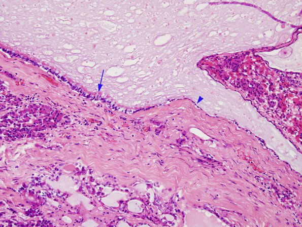 3A3 Cyst, Intermediate Lobe, (Case 3) H&E 1