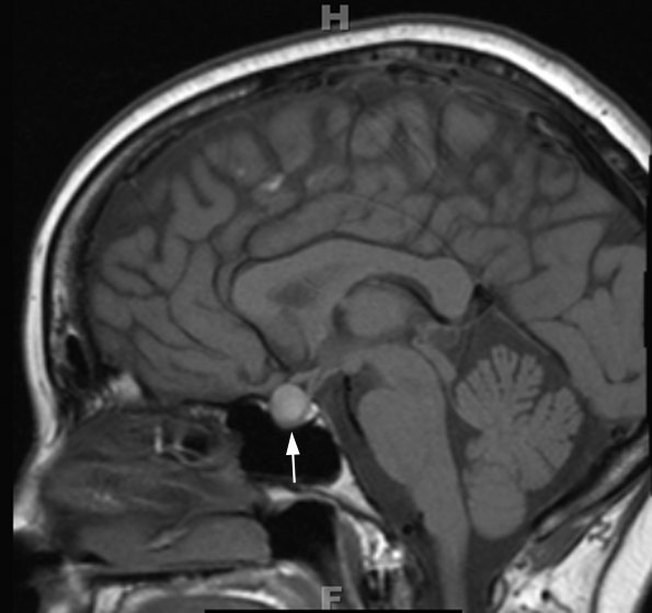 5A1 Cyst, Rathke's Cleft (Case 5) T1 3