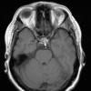 5A2 Cyst, Rathke's Cleft (Case 5) T1 4