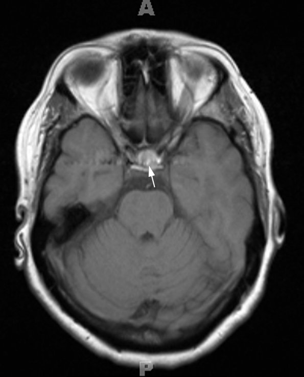 5A2 Cyst, Rathke's Cleft (Case 5) T1 4