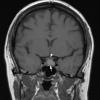 5A3 Cyst, Rathke's Cleft (Case 5) T1 5