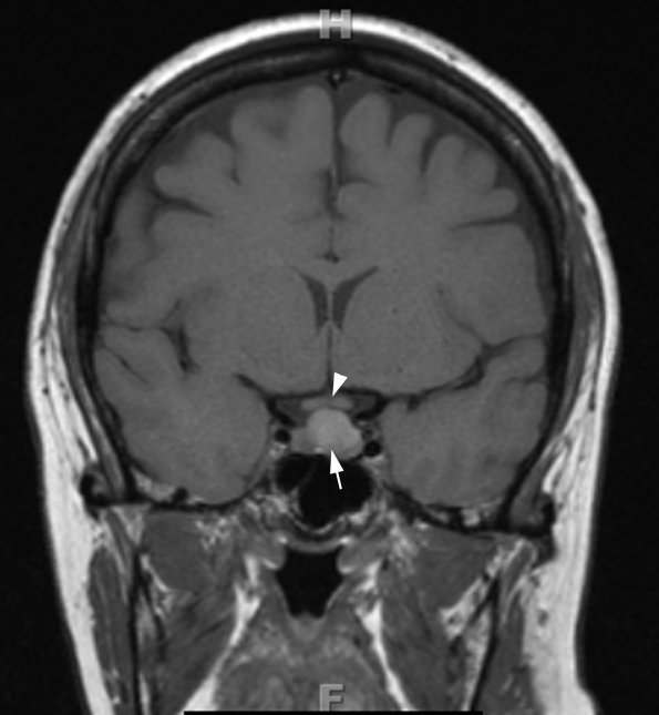 5A3 Cyst, Rathke's Cleft (Case 5) T1 5