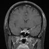 5A4 Cyst, Rathke's Cleft (Case 5) T1 W 2