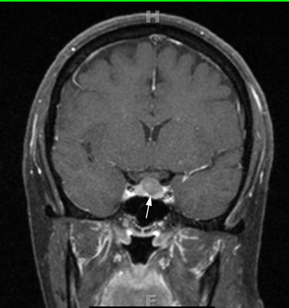 5A4 Cyst, Rathke's Cleft (Case 5) T1 W 2