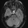 5A5 Cyst, Rathke's Cleft (Case 5) FLAIR