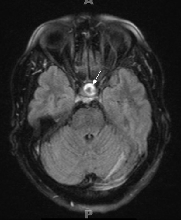 5A5 Cyst, Rathke's Cleft (Case 5) FLAIR