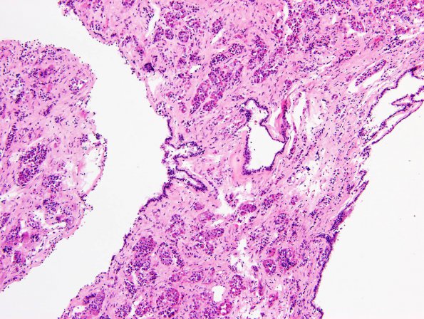 5B1 Cyst, Rathke's Cleft (Case 5) H&E 2