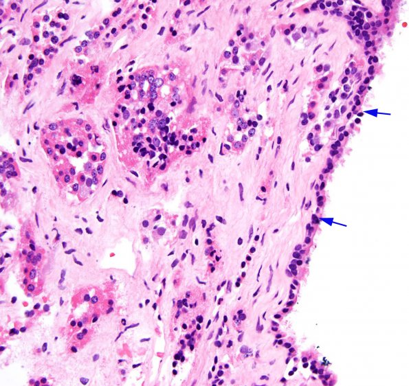 5B2 Cyst, Rathke's Cleft (Case 5) H&E 6