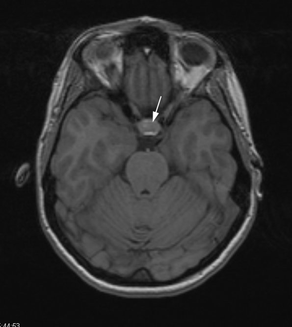 6A1 Cyst, Rathke's  (Case 6) T1 3D