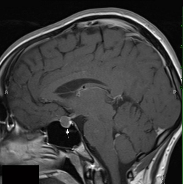 6A2 Cyst, Rathke's  (Case 6) T1 W 2