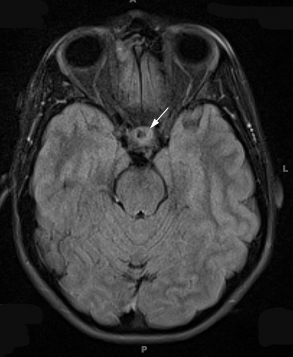 6A3 Cyst, Rathke's  (Case 6) FLAIR