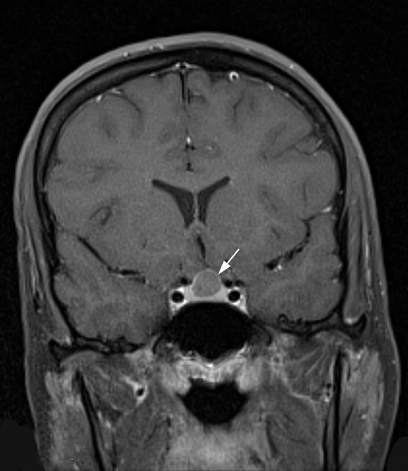 6A4 Cyst, Rathke's  (Case 6) T1 W