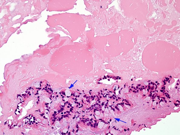 6B2 Cyst, Rathke's (Case 6) H&E 40X