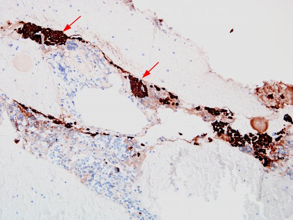 6C Cyst, Rathke's (Case 6) CK 1.2X