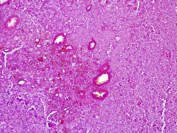 7B Cyst, Rathke, necrotic (Case 7) H&E 3