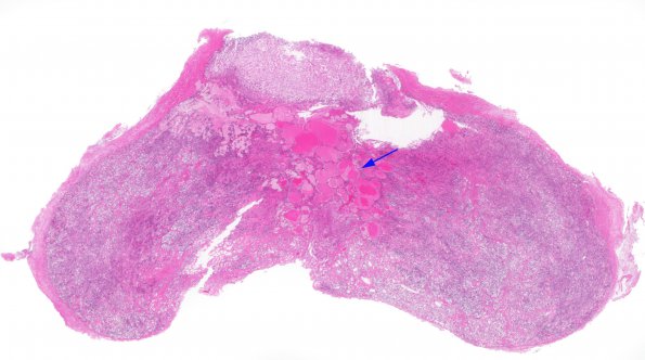 8A1 Cysts, intermediate lobe (Case 8) H&E 1