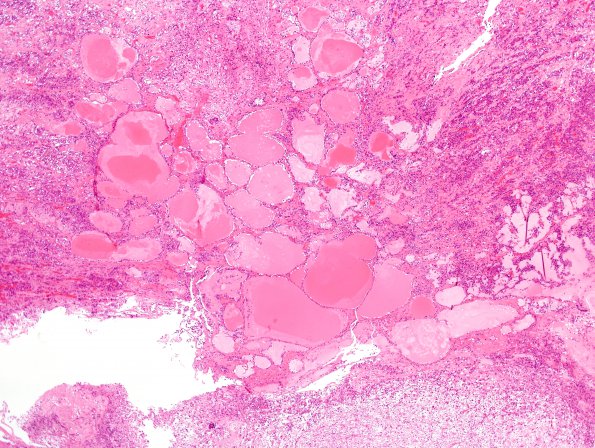 8A2 Cysts, intermediate lobe (Case 8) H&E 2A