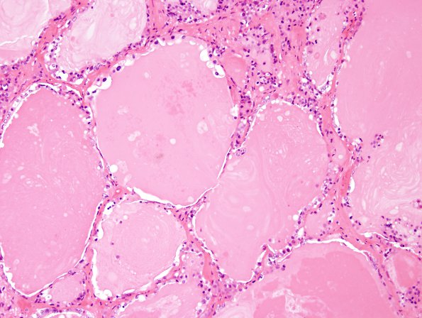 8A3 Cysts, intermediate lobe (Case 8) H&E 4