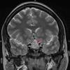 9A Hypophysitis, ruptured Rathke Cyst (Case 9) T2 HIRES W