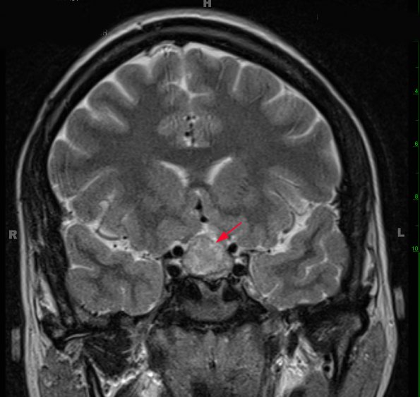 9A Hypophysitis, ruptured Rathke Cyst (Case 9) T2 HIRES W