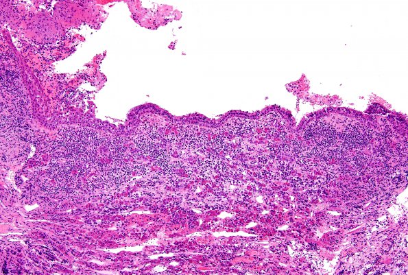 9B1 Hypophysitis, rupture Rathke Cyst (Case 9) H&E 10X