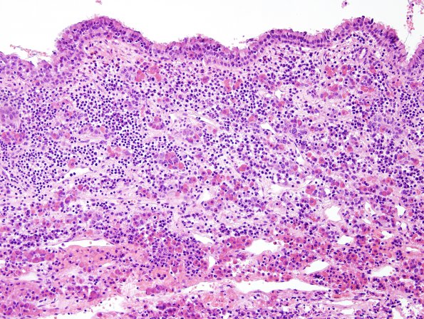 9B2 Hypophysitis, rupture Rathke Cyst (Case 9) H&E 2