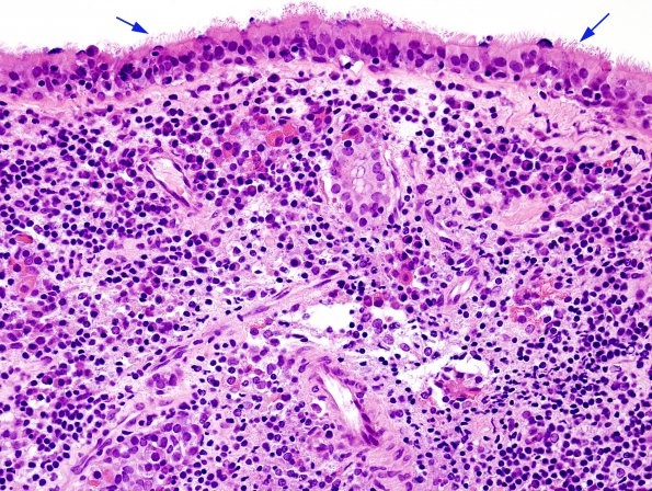 9B3 Hypophysitis, rupture Rathke Cyst (Case 9) H&E 7