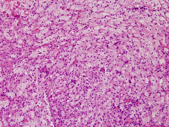 9B5 Hypophysitis, rupture Rathke Cyst (Case 9) H&E 14