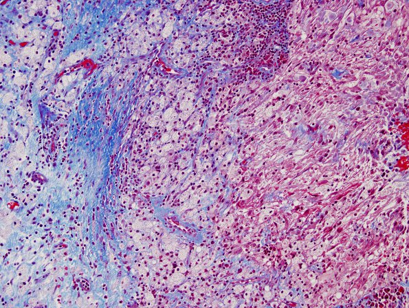 9D Hypophysitis, rupture Rathke Cyst (Case 9) Trichrome 3.