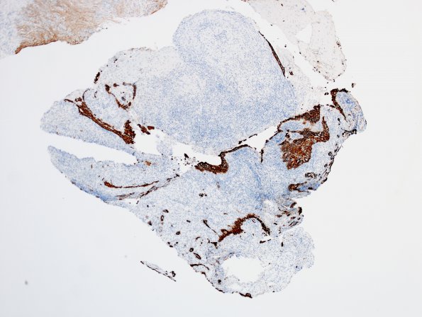 9E Hypophysitis, rupture Rathke Cyst (Case 9) CK 6