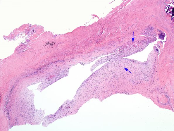 1A1 Cyst, Synovial (Case 2) H&E 1