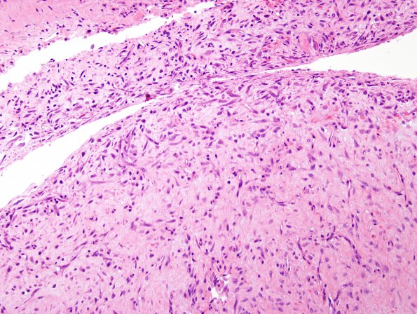 1A2 Cyst, Synovial (Case 2) H&E 2