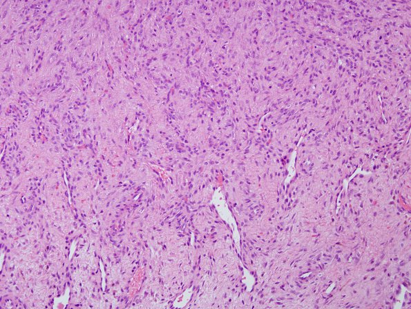 4A1 Synovial Cyst with Hyperplasia (Case 4) H&E 5