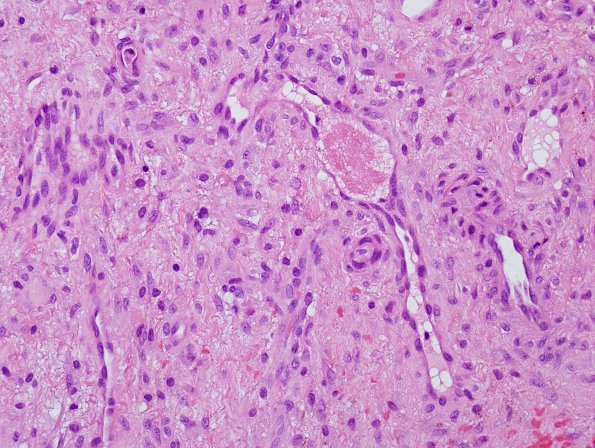 4A2 Synovial Cyst with Hyperplasia (Case 4) H&E 3