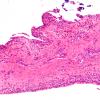 5A1 Synovial Cyst with Hyperplasia (Case 5) H&E 3 A