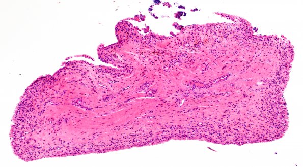 5A1 Synovial Cyst with Hyperplasia (Case 5) H&E 3 A