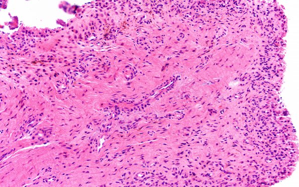 5A2 Synovial Cyst with Hyperplasia (Case 5) H&E 3 A