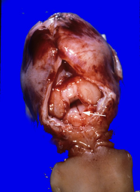 10 Dandy-Walker Deformity (Case 9) 1A